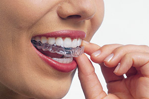 Invisalign® and Invisalign® Teen